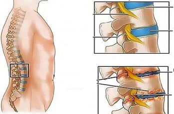Le ragioni dello sviluppo dell'osteocondosi lombare