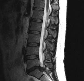 Opzioni diagnostiche per l'osteocondosi lombare