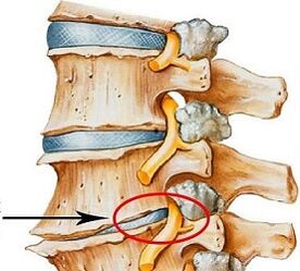 Perché è l'osteocondosi lombare