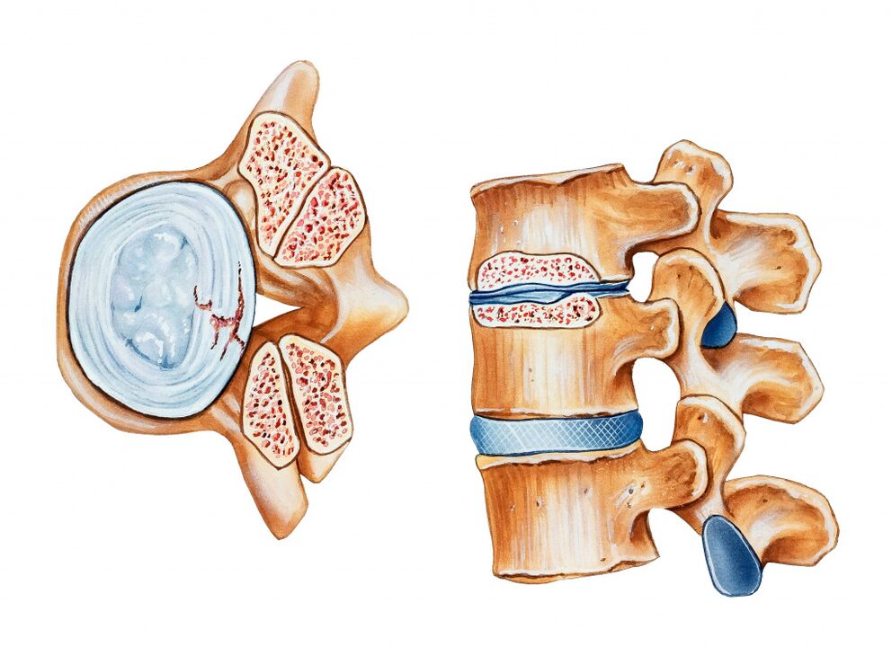 L'osteocondosi della regione cervicale porta alla distruzione dei dischi intervertebrali