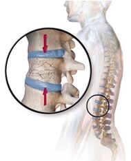 L'osteoporosi provoca mal di schiena nella parte bassa della schiena